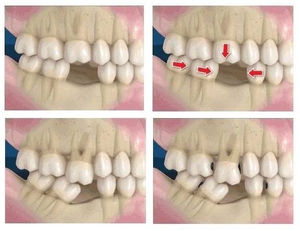 PREJUIZOS CAUSADOS PELA AUSÊNCIA DENTAL